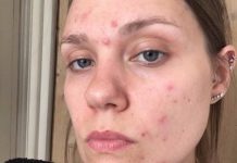 Ученые обнаружили генетические регионы, связанные с развитием акне