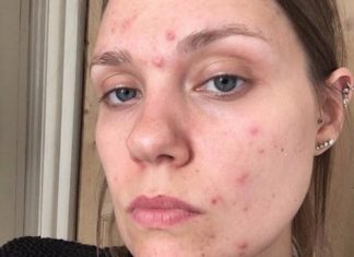 Ученые обнаружили генетические регионы, связанные с развитием акне