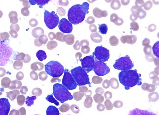 Ученые нашли новый подход к подавлению острой лейкемии