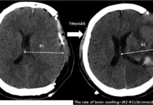 Отек мозга можно уменьшить при помощи одного гена