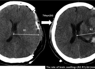 Отек мозга можно уменьшить при помощи одного гена