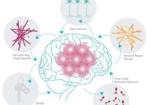 Лечение Альцгеймера световой терапией дает результаты