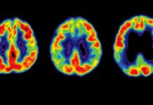Регулярная чистка зубов может предупредить развитие Альцгеймера