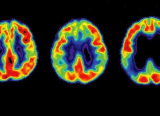 Регулярная чистка зубов может предупредить развитие Альцгеймера