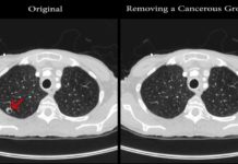 Ученые научились удалять узлы на сканировании