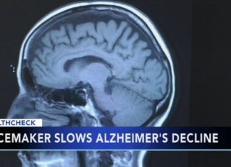 Представлен новый электростимулятор для мозга