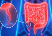 Аппендицит может играть существенную роль в развитии болезни Паркинсона