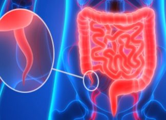 Аппендицит может играть существенную роль в развитии болезни Паркинсона