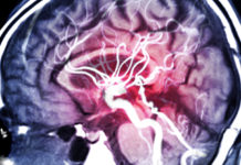 Создан ИИ, который может помочь в борьбе с эпилепсией