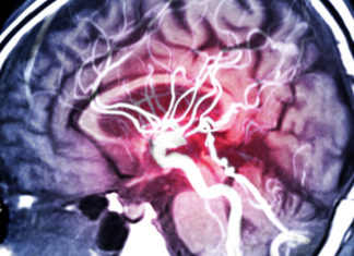 Создан ИИ, который может помочь в борьбе с эпилепсией