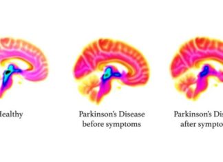 Ученые создали тренажер для пациентов с синдромом Паркинсона