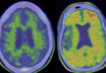 Медики возобновили тесты с использованием старого лекарства от Альцгеймера