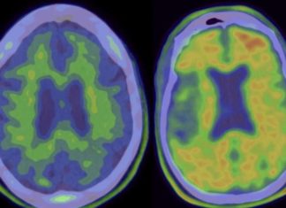 Медики возобновили тесты с использованием старого лекарства от Альцгеймера
