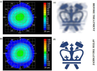 Представлен неинвазивный метод лечения миопии