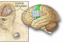Новый тип мозгового импланта останавливает припадки