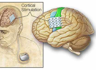 Новый тип мозгового импланта останавливает припадки