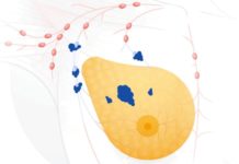 Google AI обнаруживает результаты рака груди на радиограммах