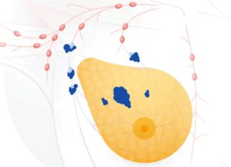 Google AI обнаруживает результаты рака груди на радиограммах