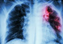 Ученые разобрали сложную структуру туберкулеза