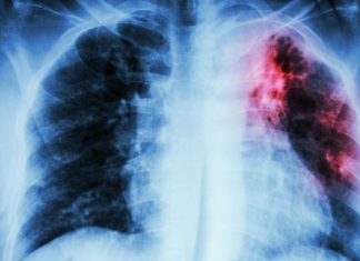 Ученые разобрали сложную структуру туберкулеза