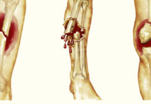 OsteoDetect AI – новый ИИ для обнаружения переломов