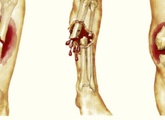 OsteoDetect AI – новый ИИ для обнаружения переломов