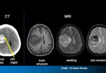 Обнаружен ген, играющий важную роль в возникновении отека мозга