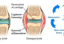 Некоторые инъекции обезбаливающих могут ухудшать состояние хрящей