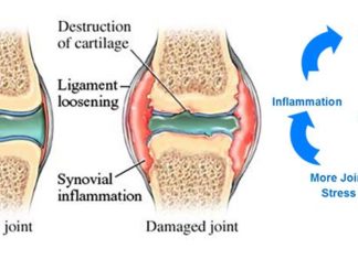Некоторые инъекции обезбаливающих могут ухудшать состояние хрящей