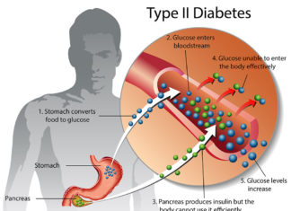Обнаружен новый триггер сахарного диабета второго типа