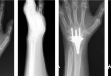 Создан революционный имплант запястья KinematX