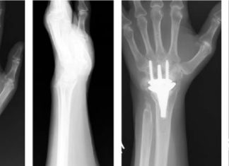 Создан революционный имплант запястья KinematX