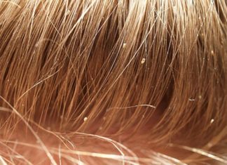 Вши любят чистые волосы – правда или миф