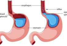 Ученые установили реальную степень пользы желудочного шунтирования