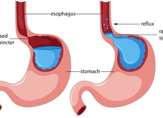 Ученые установили реальную степень пользы желудочного шунтирования