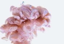 Синдром Альцгеймера может развиться вследствие некоторых инфекций