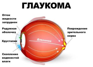 Глаукома – диагностика и быстрое лечение
