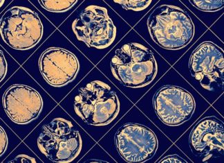 IBM разработала ИИ, помогающий людям с болезнью Паркинсона